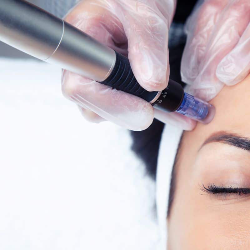 Morpheus8 treatment Wymondham from Lipo Sculpt - Book in today!